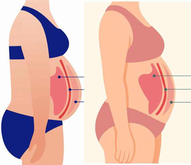 висцеральный жир-04